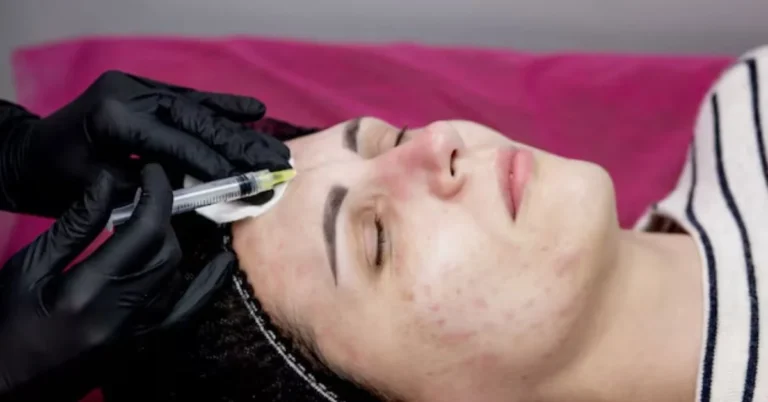 Microneedling